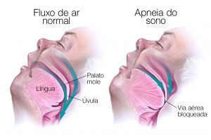 Apneia do sono: uma ameaça silenciosa à saúde